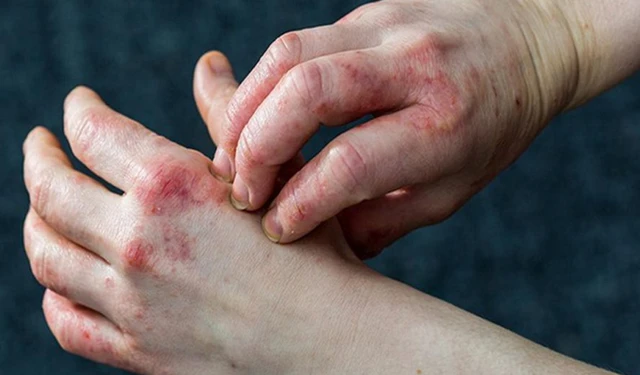 bai-viet/phan-biet-eczema-va-hac-lao-nhu-the-nao-55084.html