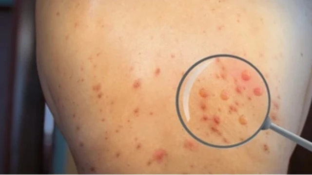 bai-viet/phan-biet-hinh-anh-benh-dau-mua-khi.html