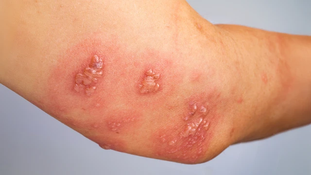 bai-viet/phan-biet-hinh-anh-ghe-phong-va-nhan-biet-khi-nao-can-den-benh-vien.html