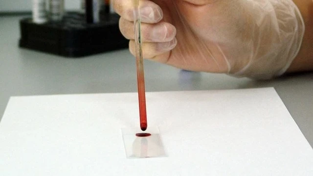 bai-viet/phan-tich-ket-qua-xet-nghiem-thieu-mau-giup-danh-gia-muc-do-benh-chinh-xac.html