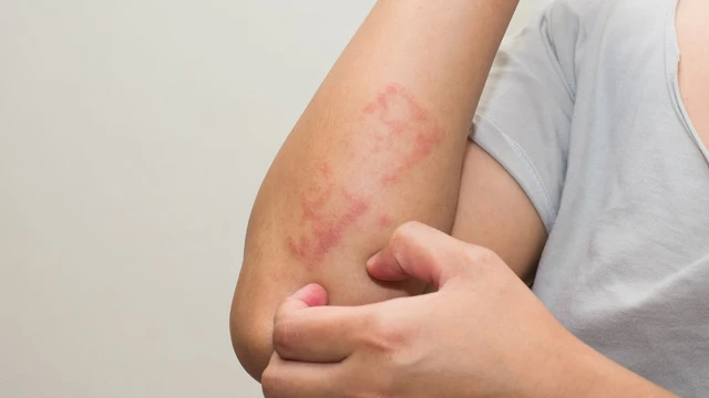 bai-viet/phat-ban-hiv-la-gi-nguyen-nhan-trieu-chung-va-cach-dieu-tri-68378.html