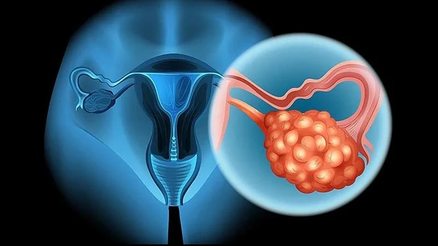 bai-viet/phat-hien-buong-trung-phai-co-nang-19mm-co-can-mo-khong.html