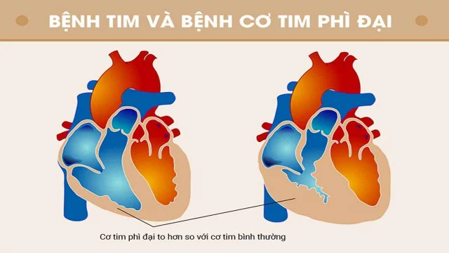 bai-viet/phau-thuat-dieu-tri-benh-co-tim-phi-dai-cho-tre-va-nhung-dieu-can-luu-y.html