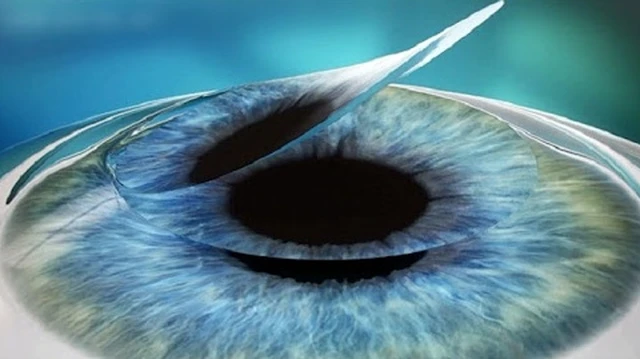 bai-viet/phau-thuat-femtosecond-lasik-dieu-tri-tat-khuc-xa-mat-60446.html