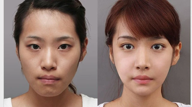 bai-viet/phau-thuat-ham-ho-bao-lau-thi-lanh-nhung-luu-y-sau-khi-thuc-hien.html