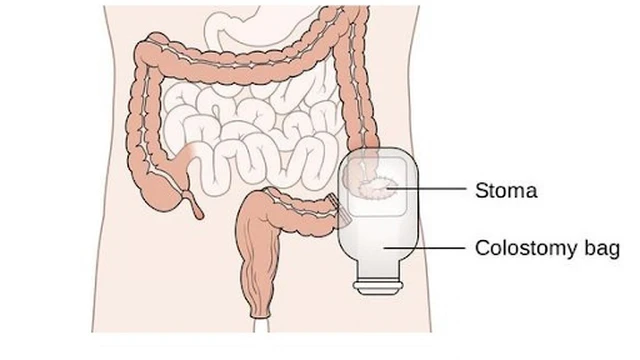 bai-viet/phau-thuat-lam-hau-mon-nhan-tao-56982.html