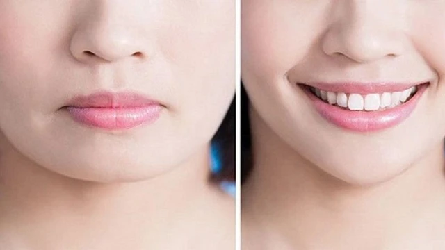 bai-viet/phau-thuat-mieng-cuoi-phuong-phap-can-thiep-tham-my-duoc-ua-chuong.html