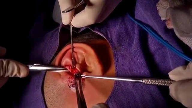 bai-viet/phau-thuat-ro-luan-nhi-het-bao-nhieu-tien-59503.html