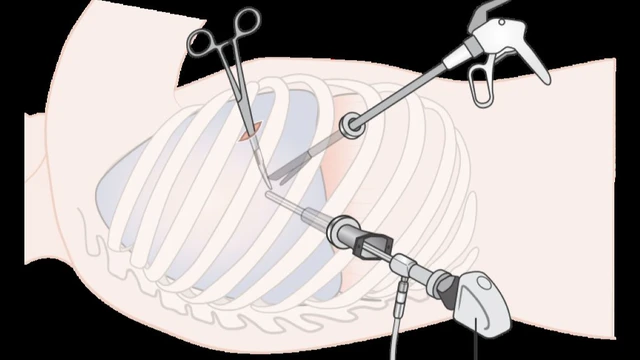 bai-viet/phau-thuat-trung-that-qua-noi-soi-long-nguc.html