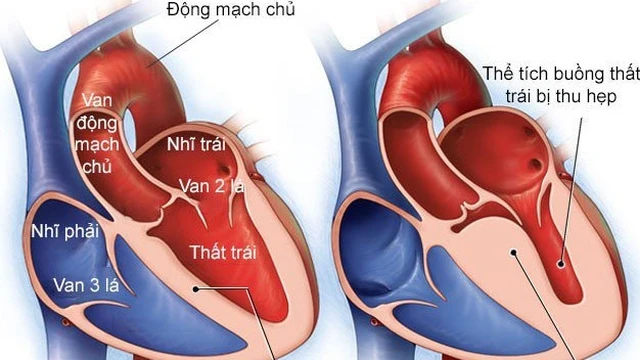 bai-viet/phi-dai-tam-that-o-tim-la-gi-nguyen-nhan-va-dau-hieu-nhan-biet-benh-the-nao.html
