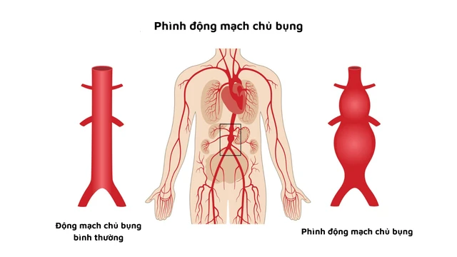 benh/phinh-dong-mach-chu-bung.html