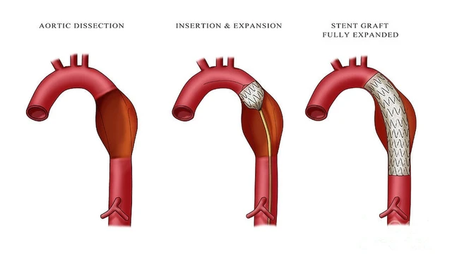 bai-viet/phinh-dong-mach-chu-nguyen-nhan-trieu-chung-va-cach-dieu-tri-hieu-qua.html