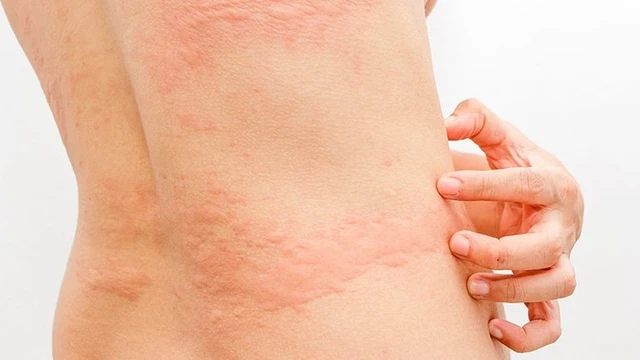 bai-viet/phu-nu-bi-noi-me-day-sau-sinh-uong-thuoc-gi-54534.html