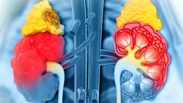 bai-viet/phuong-phap-chan-doan-hinh-anh-u-than-va-cach-phong-ngua-benh.html