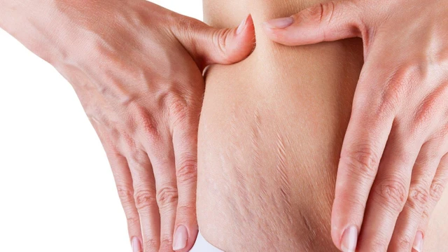 bai-viet/phuong-phap-dieu-tri-tinh-trang-cang-da-bung-hieu-qua.html