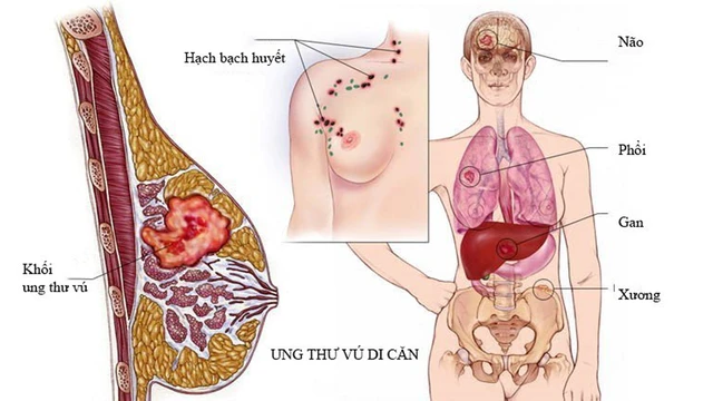 bai-viet/phuong-phap-dieu-tri-ung-thu-vu-di-can-phoi-56583.html