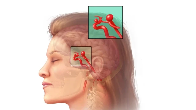 bai-viet/tim-hieu-chi-tiet-ve-phuong-phap-nut-tui-phinh-dong-mach-nao.html