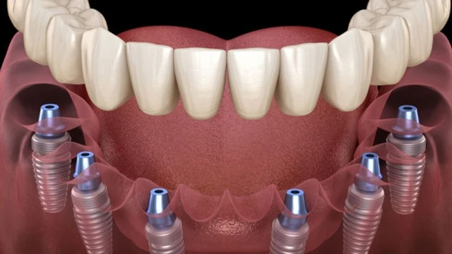 bai-viet/phuong-phap-trong-rang-implant-all-on-6-co-uu-diem-gi.html