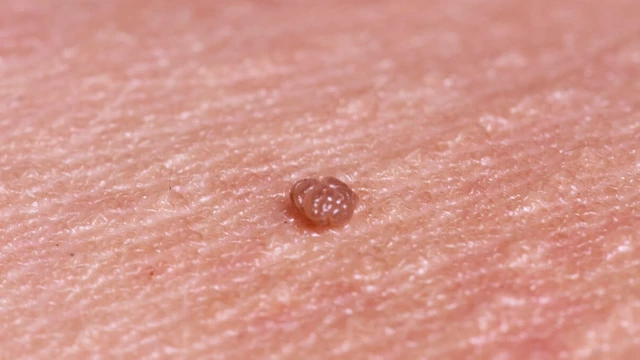 bai-viet/phuong-phap-xit-al-co-het-sui-mao-ga-khong-cac-bien-phap-dieu-tri-sui-mao-ga.html