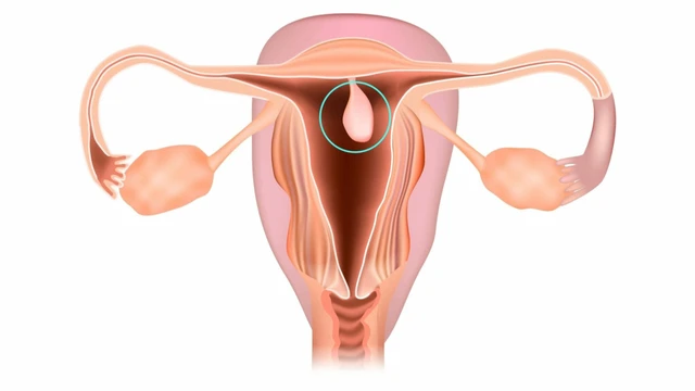 Polyp buồng tử cung
