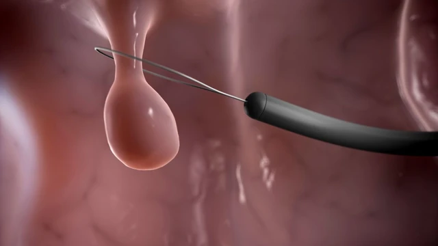 bai-viet/cat-polyp-dai-trang-co-moc-lai-khong-cach-phong-ngua-polyp-dai-trang-hieu-qua.html