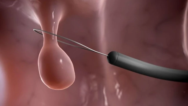 bai-viet/polyp-dai-trang-nghich-san-va-nhung-dieu-can-biet.html