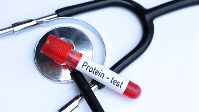 bai-viet/protein-mau-tang-trong-nhung-truong-hop-nao.html