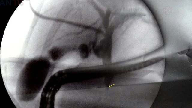 bai-viet/ptbd-duong-mat-la-gi-va-mot-so-thong-tin-can-biet-ve-ptbd-duong-mat.html