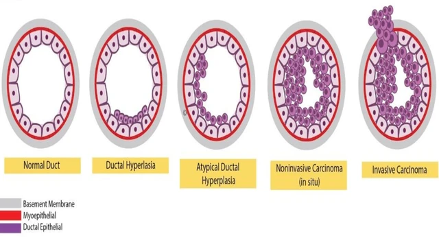 bai-viet/qua-san-khong-dien-hinh-tuyen-vu-co-phai-la-ung-thu.html