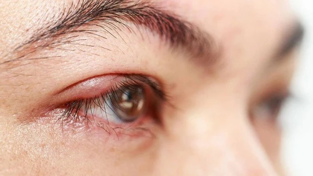 bai-viet/quam-mi-la-gi-tinh-trang-nay-co-nguy-hiem-khong.html