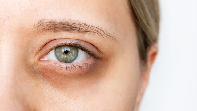 bai-viet/quang-tham-mat-co-phai-bieu-hien-cua-benh-khong-cach-tri-quang-tham-mat.html