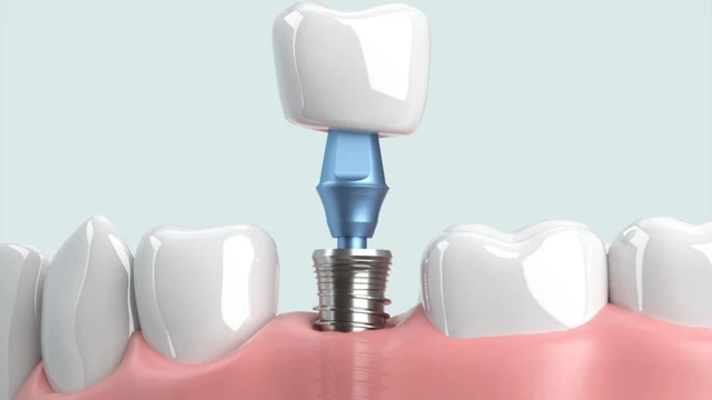 bai-viet/quy-trinh-cay-ghep-implant-cho-nhung-benh-nhan-bi-mat-rang.html