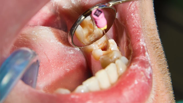 bai-viet/quy-trinh-lay-tuy-rang-5-buoc-chuan-y-khoa-va-cach-cham-soc-an-toan.html