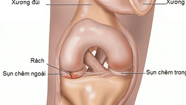 bai-viet/rach-sun-chem-bao-lau-thi-khoi-can-chu-y-dieu-gi-khi-thuc-hien-cac-bai-tap-phuc-hoi-chuc-nang-56803.html