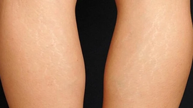 bai-viet/ran-da-chan-mau-trang-nguyen-nhan-va-cach-khac-phuc-57711.html