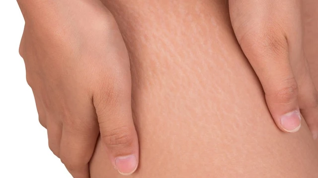 bai-viet/ran-da-chan-o-nam-nguyen-nhan-va-cach-khac-phuc-57712.html