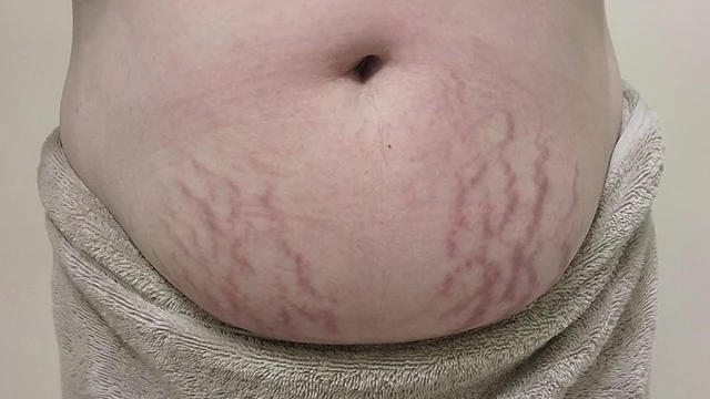 bai-viet/ran-da-mau-tim-co-het-khong-cach-dieu-tri-va-phong-ngua.html