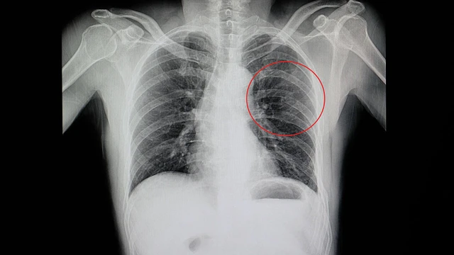 bai-viet/ran-xuong-suon-nguyen-nhan-dau-hieu-va-cach-phong-ngua.html