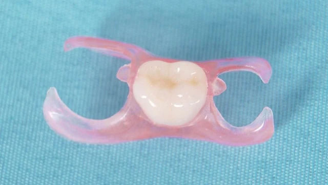 bai-viet/rang-gia-thao-lap-1-chiec-va-uu-nhuoc-diem-cua-tung-loai.html