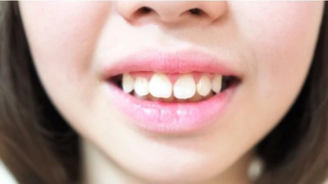 bai-viet/rang-ho-nhe-nguyen-nhan-tac-hai-va-phuong-phap-khac-phuc.html