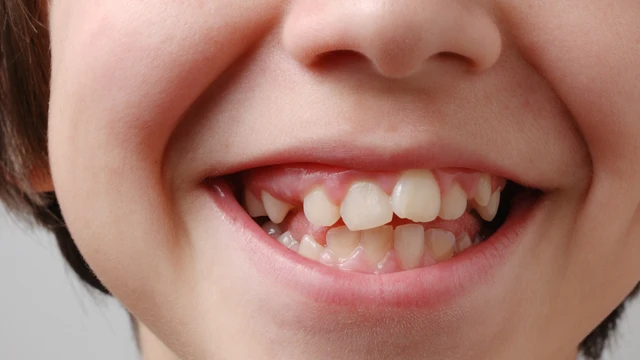 bai-viet/rang-khenh-moc-nhu-the-nao-2-phuong-phap-tao-rang-khenh-pho-bien-hien-nay.html