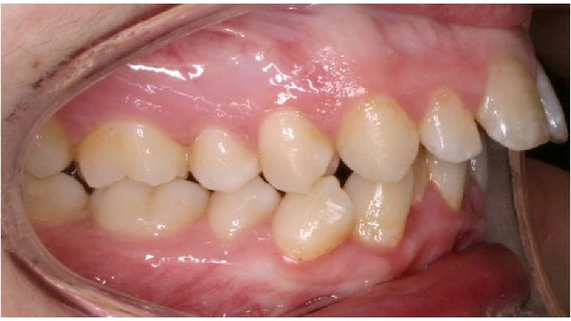 bai-viet/rang-loi-xi-la-gi-nguyen-nhan-va-cach-dieu-tri.html