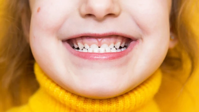 bai-viet/rang-mom-va-nhung-giai-phap-khac-phuc-hieu-qua.html