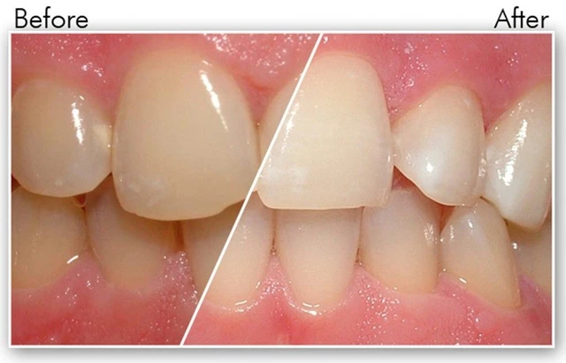 bai-viet/rang-nhiem-fluor-la-nhu-the-nao-co-dieu-tri-duoc-khong-55483.html