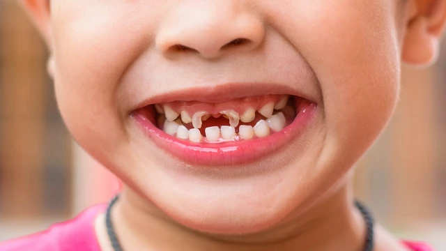 bai-viet/rang-sua-la-gi-thong-tin-quan-trong-can-biet-ve-rang-sua.html