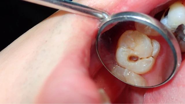 bai-viet/rang-vinh-vien-moi-moc-bi-sau-vao-tuy-muc-do-nguy-hiem-va-cach-dieu-tri.html