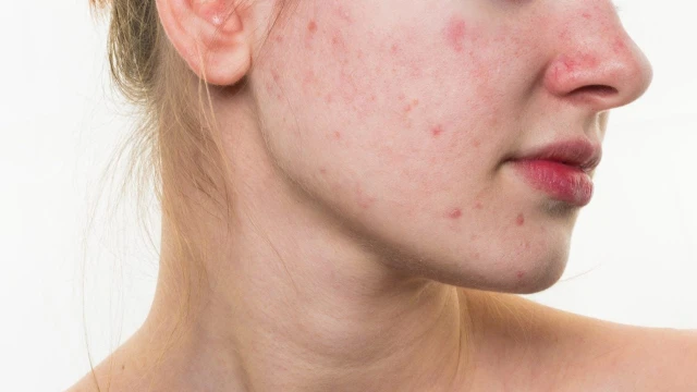 bai-viet/review-kem-chong-nang-eucerin-cho-da-mun-61606.html