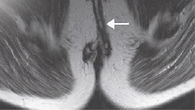 bai-viet/ro-hau-mon-hinh-mong-ngua-nguyen-nhan-chan-doan-cach-dieu-tri-va-phong-ngua.html