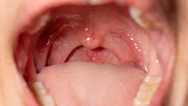 bai-viet/niem-mac-mieng-la-gi-vai-tro-cua-niem-mac-trong-viec-bao-ve-khoang-mieng.html