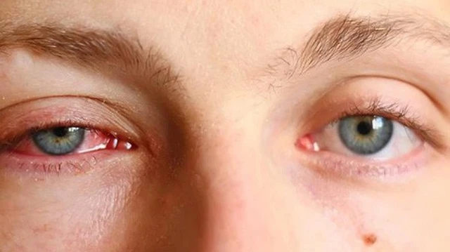 bai-viet/roi-loan-tuyen-le-nguyen-nhan-trieu-chung-cach-dieu-tri-benh-hieu-qua.html